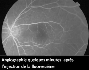 Angiographie après injection de fluorescéine