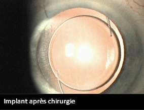 Implant après chirurgie