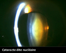 Cataracte dite nucléaire