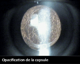 Opacification de la capsule