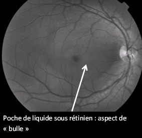 Poche de liquide sous-rétinien