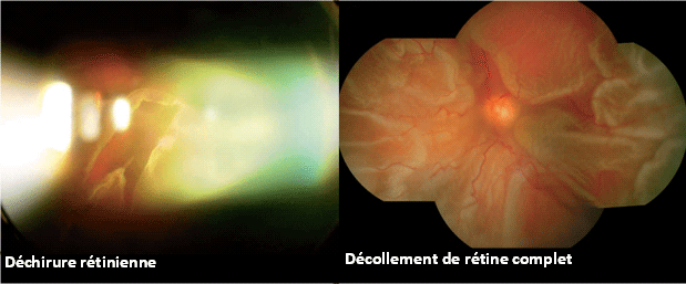 Illustration des déchirure et décollement rétiniens