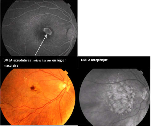 Illustrations de la DMLA