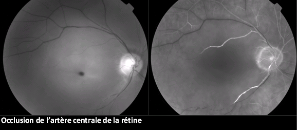 Occlusion de l'artère centrale de la rétine