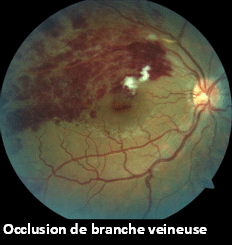 Occlusion de branche veineuse