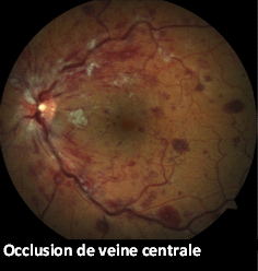 Occlusion de veine centrale