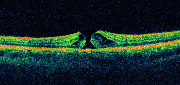 Illustration trou maculaire 2